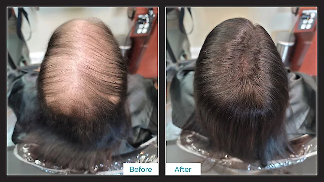Toupee Hair Replacement - Before & After