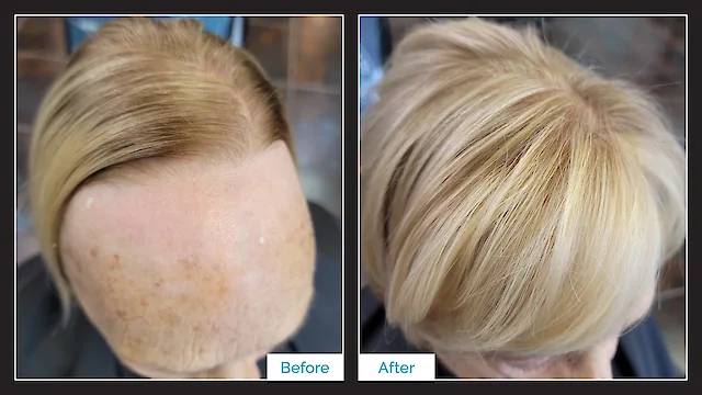 Toupee Hair Replacement - Before & After
