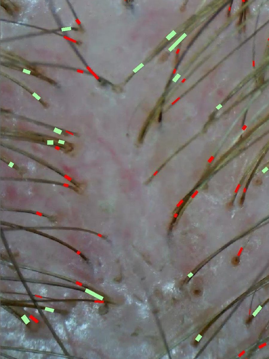 Scalp analysis and treatment by clinically certified trichologist Kristan Sayers addressing hair loss at K Bella Hair Studio & Spa in Brighton, MI - after transformation