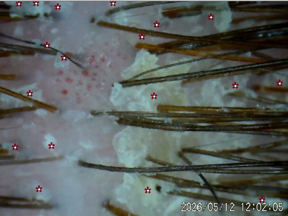 Magnified trichoscope view of scalp showing seborrheic dermatitis with visible flaking and inflammation, annotated with measurement points by Kristan Sayers at K Bella Hair Studio & Spa in Brighton, MI