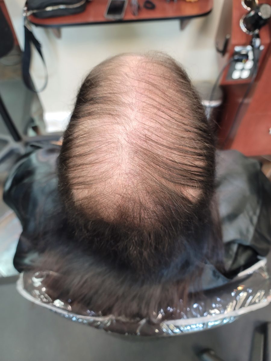 toupee Hair Replacement - Before & After before treatment by certified cranial prosthesis specialist Kristan Sayers at K Bella Hair Studio in Brighton, MI