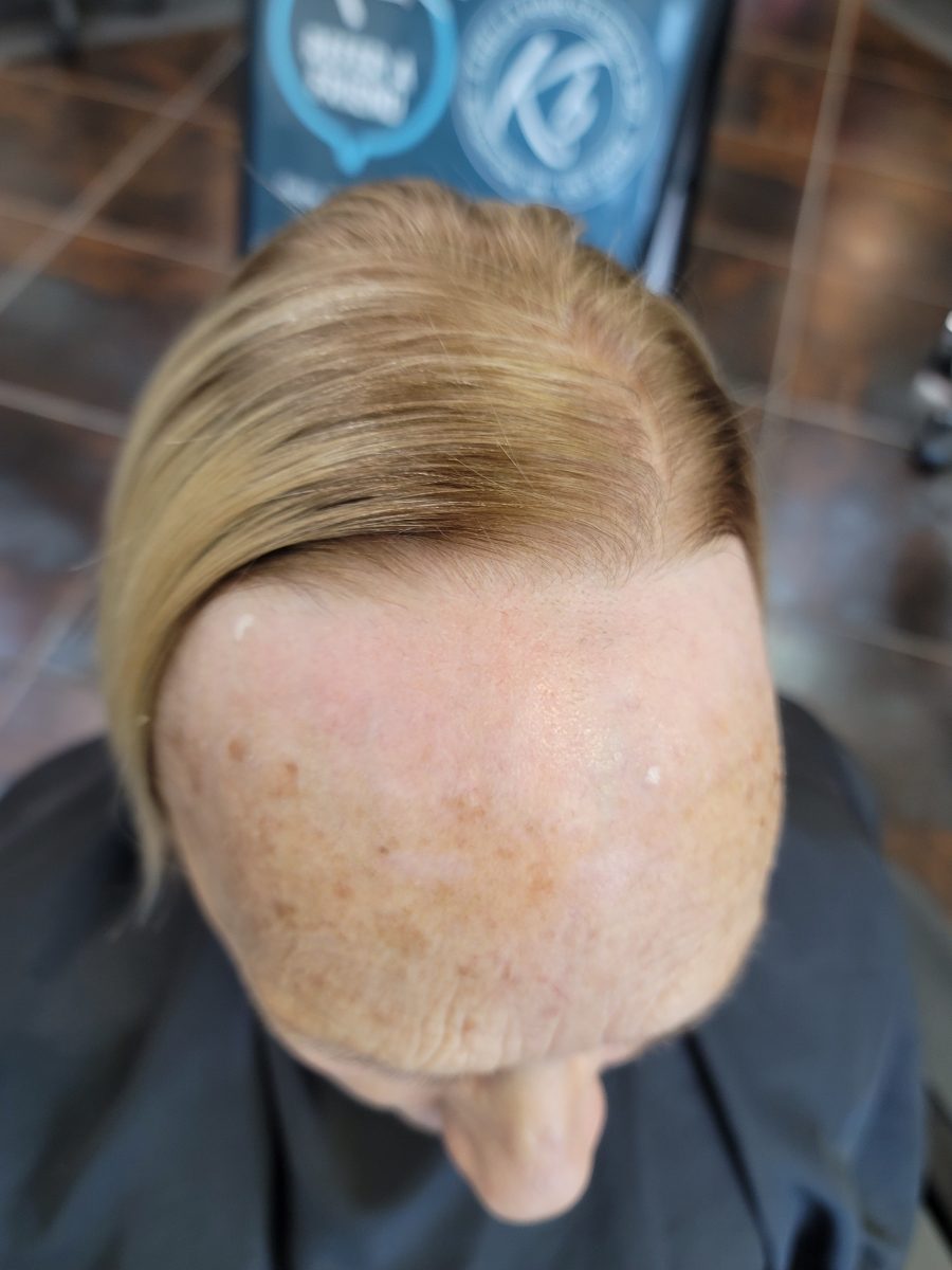 toupee Hair Replacement - Before & After before treatment by certified cranial prosthesis specialist Kristan Sayers at K Bella Hair Studio in Brighton, MI