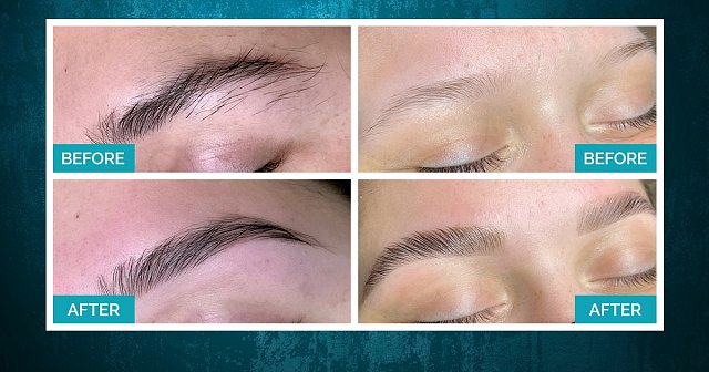 Complete Brow Rehabilitation Services