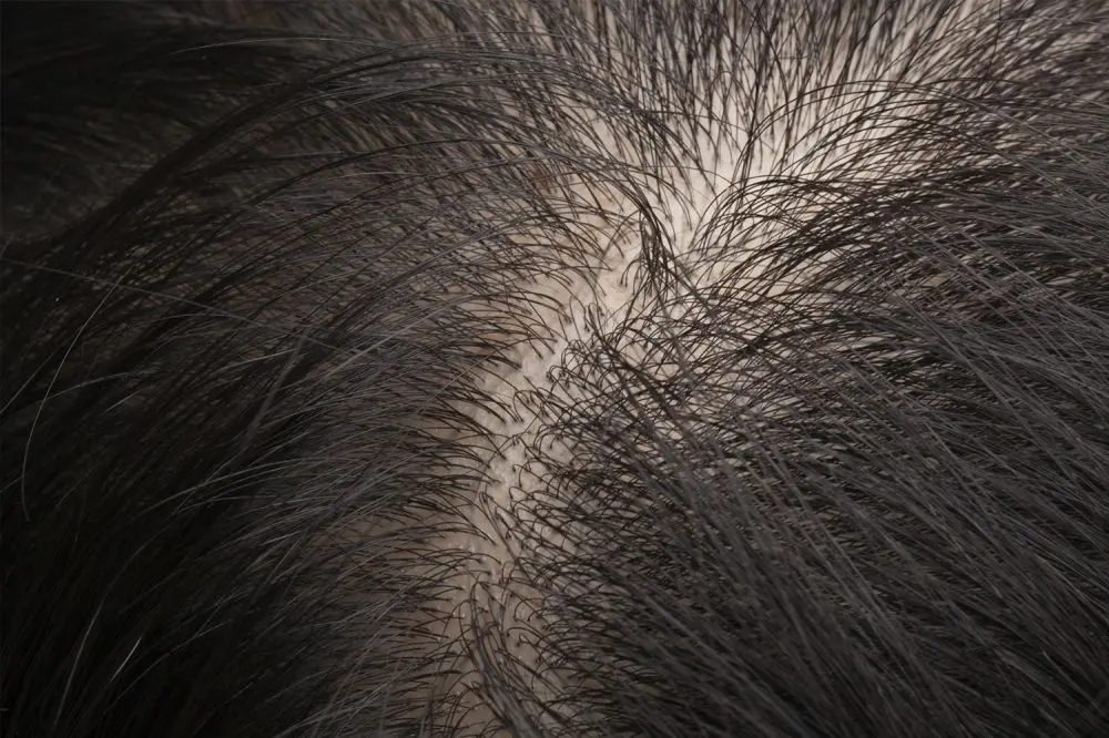 Thinning Balding Hair