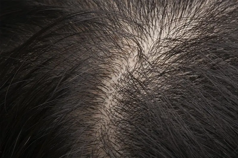 Thinning Balding Hair