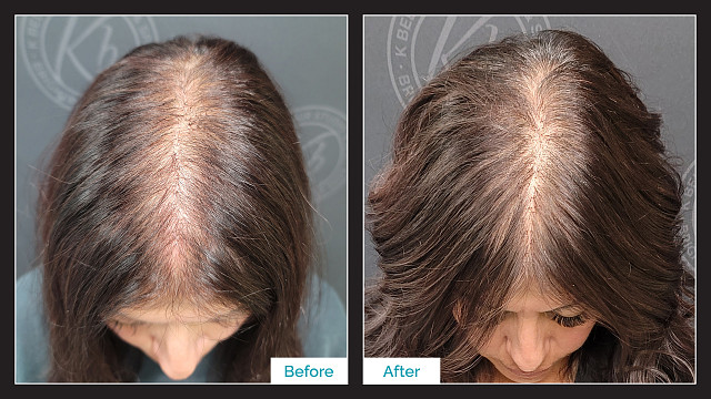 MicroPoint Non-Surgical Hair Replacement