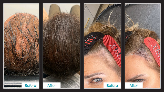 Scalp Micropigmentation Before & After